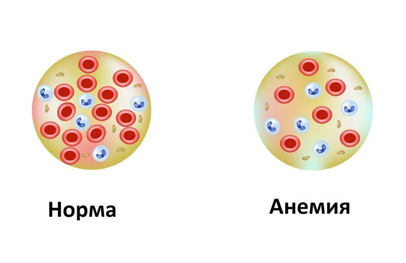Симптомы анемии у беременных