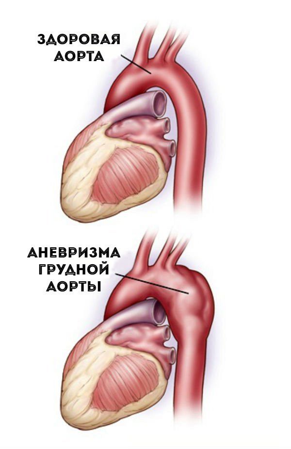 Средостение в рентгеновском изображении