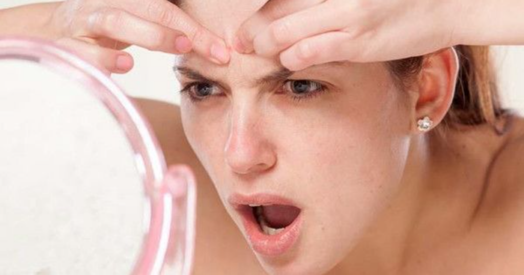 Акне у взрослых: на что обратить внимание?