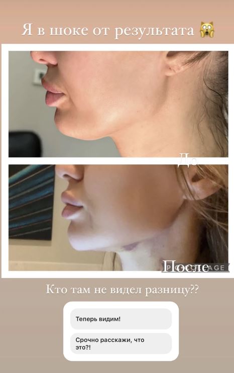 Боня показала результат пластической операции