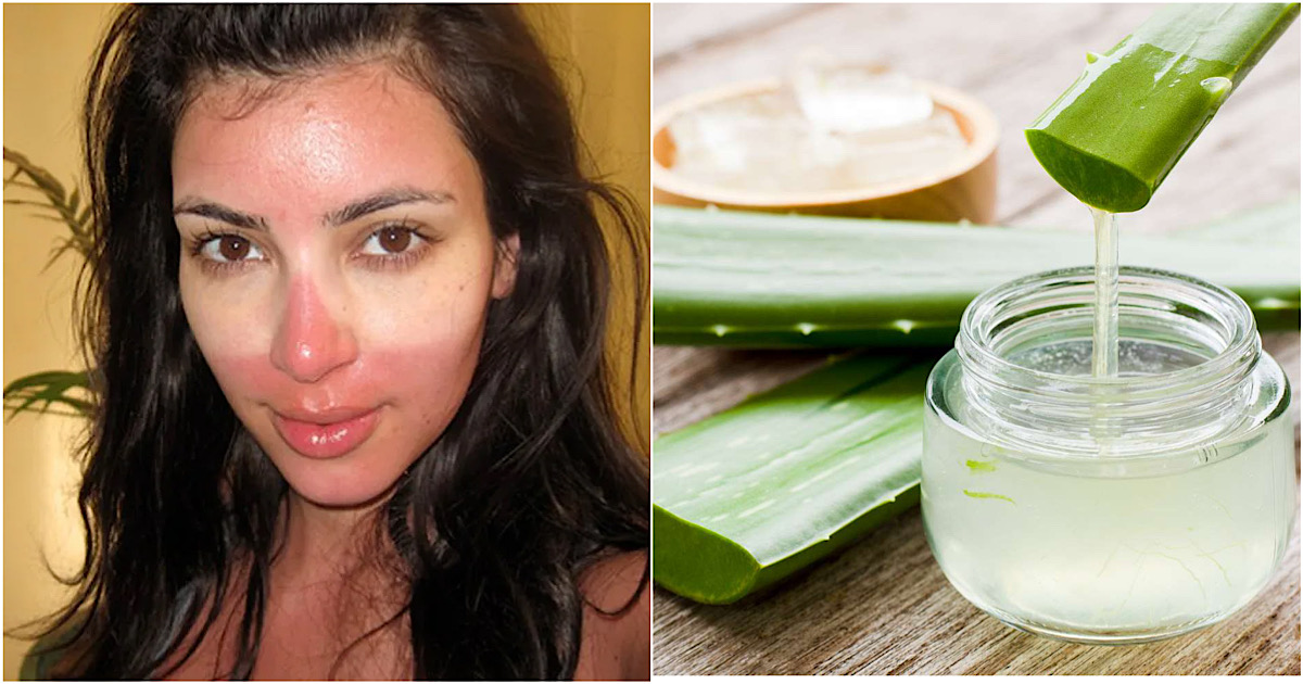 Что делать при солнечном ожоге