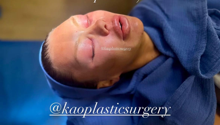 Пластический хирург опубликовал фото Бони после операции