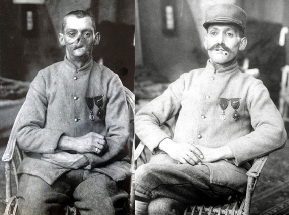 Как Первая мировая подняла спрос на маски для людей с увечьями