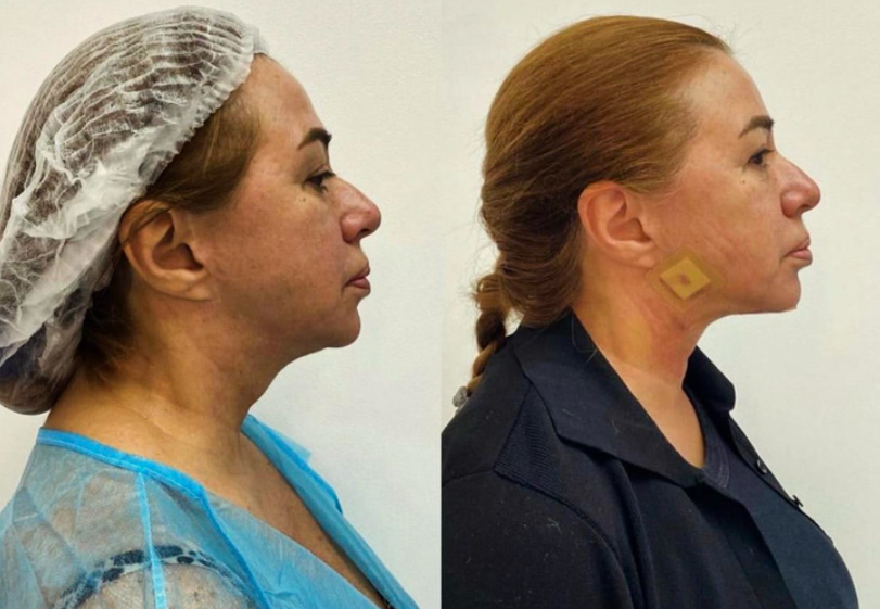Апина изменила внешность с помощью пластической хирургии
