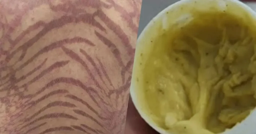 На коже женщины после самолечения появились необычные узоры