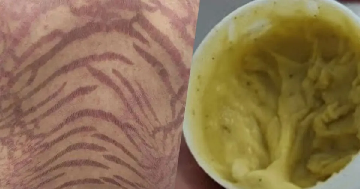 На коже женщины после самолечения появились необычные узоры На коже женщины после самолечения появились необычные узоры