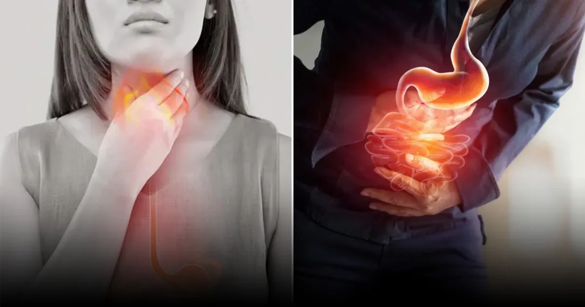 Гастроэнтеролог рассказал, как избавиться от изжоги без медикаментов Гастроэнтеролог рассказал, как избавиться от изжоги без медикаментов