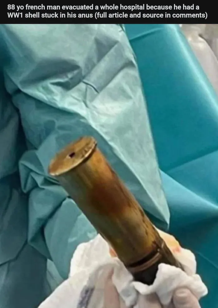 Во Франции из кишечника 88-летнего мужчины достали старинный снаряд